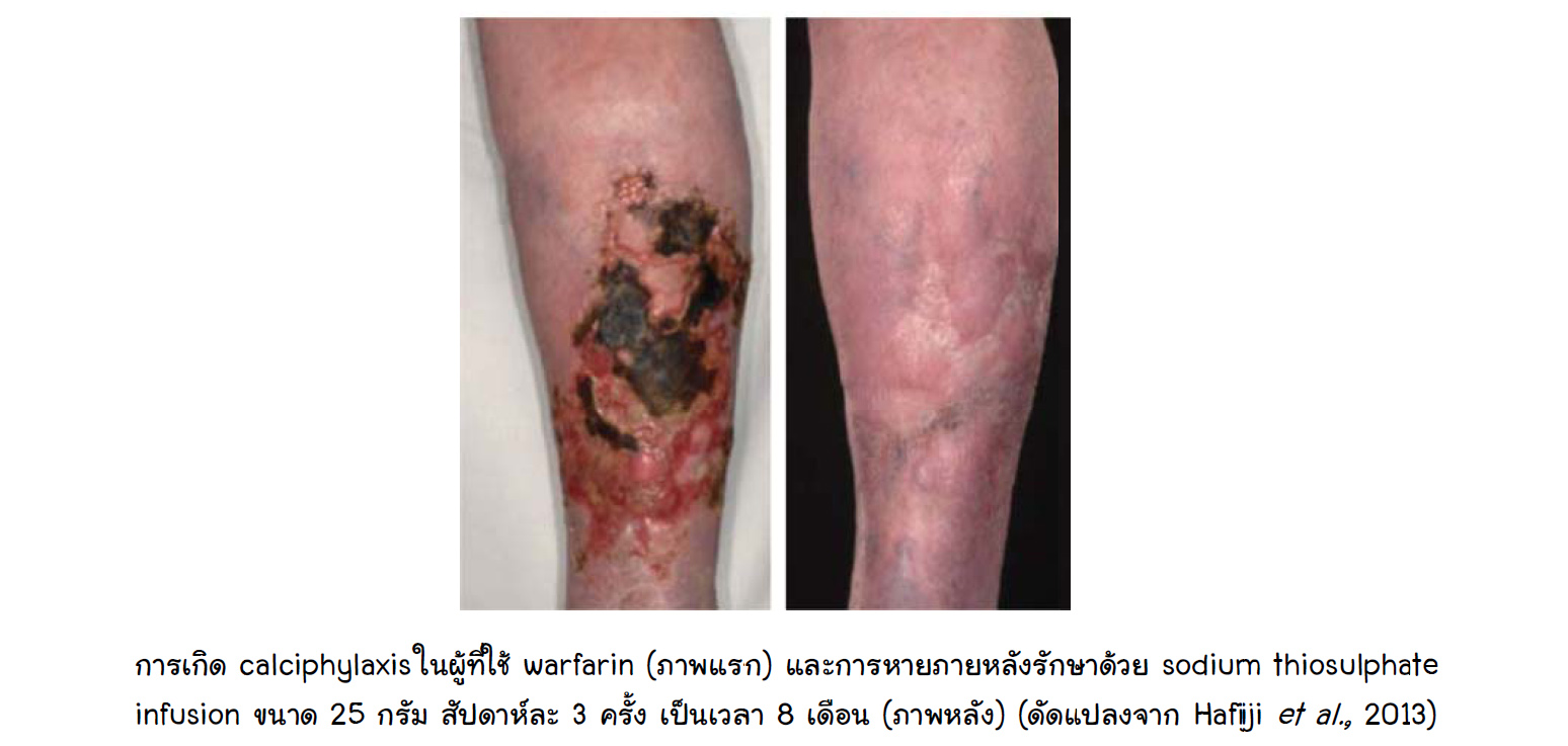 warfarin induced calciphylaxis