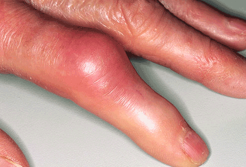 Totul despre guta (artrita gutoasa): Simptome, Factori de risc & Tratament | Doc.ro